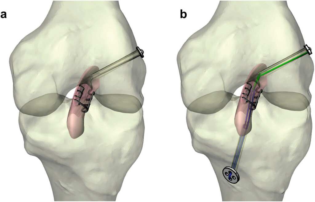 Ligament Augmentation Industry