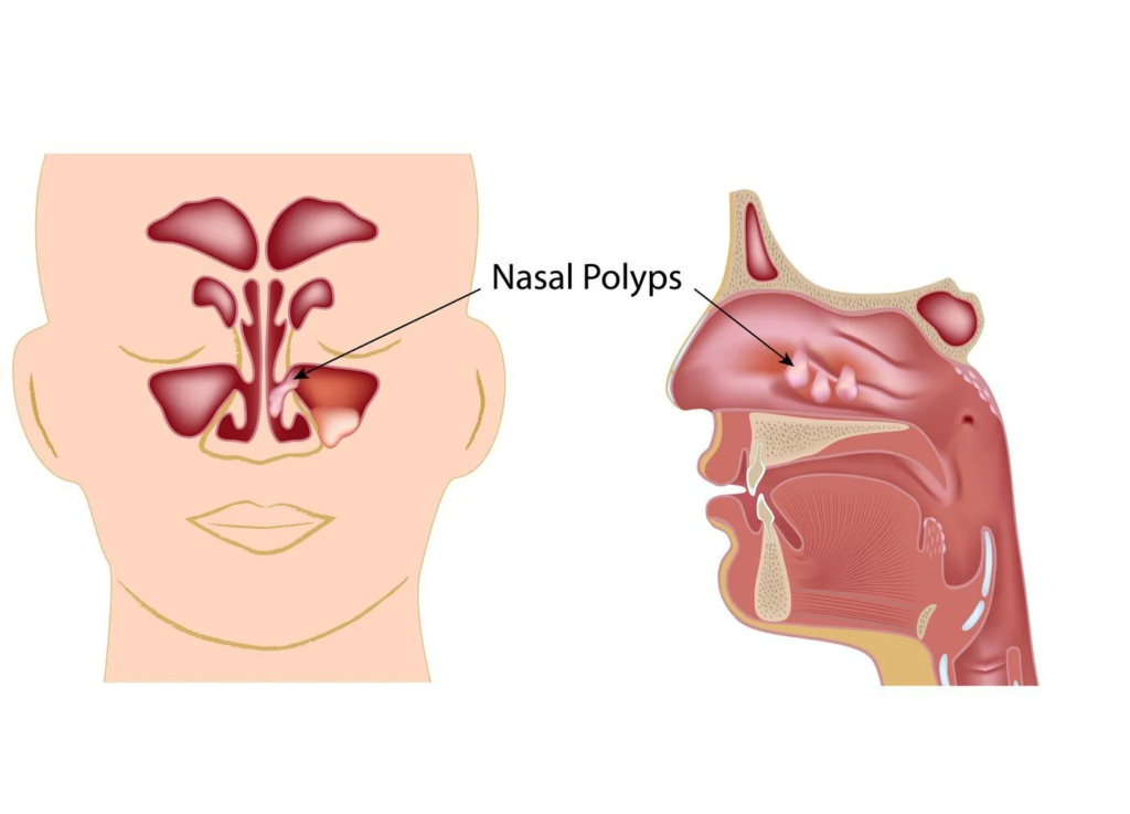 Nasal Polyposis Treatment Industry