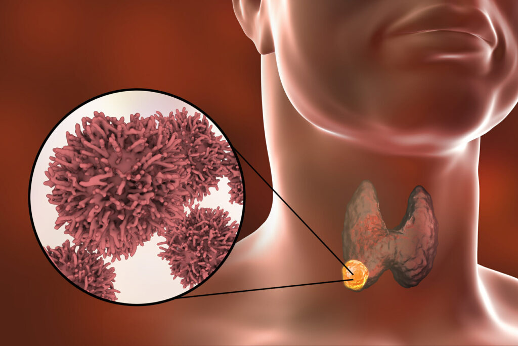 Neuroendocrine Carcinoma Treatment Industry