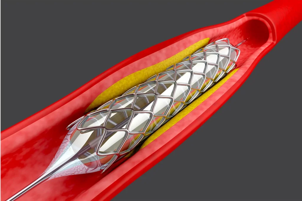 Non-Vascular Stents Market