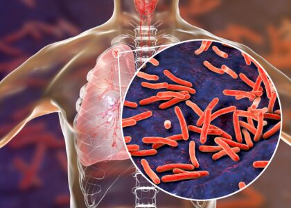 Global Ocular Tuberculosis Therapeutics Industry