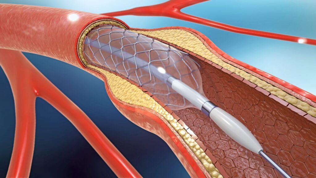 Peripheral Vascular Devices Market