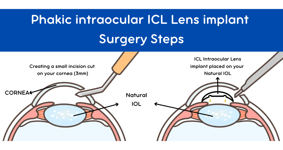 Phakic Intraocular Lenses (IOL) Industry