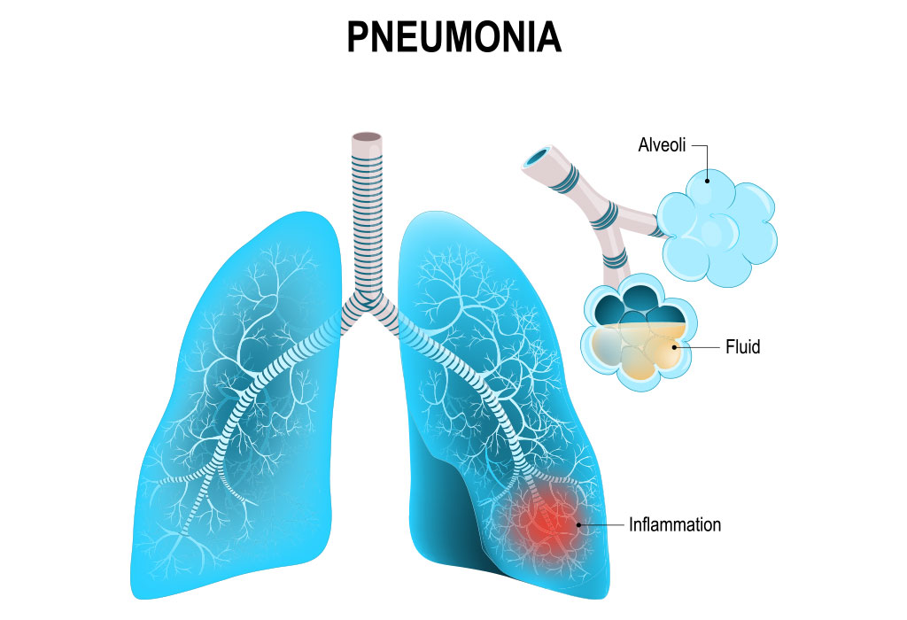 Pneumonia Diagnostics Industry