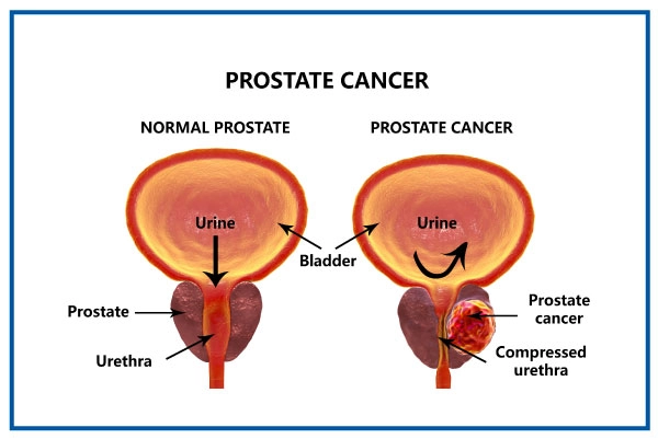 Prostate Cancer Industry