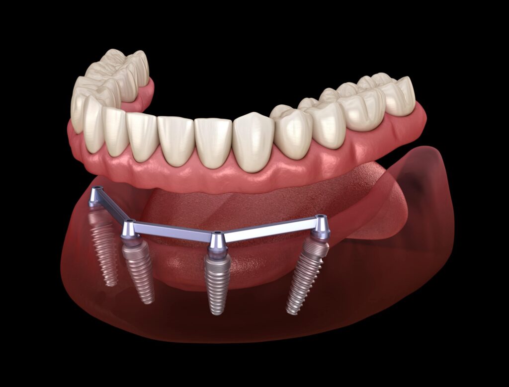 Removable Partial Dentures Industry