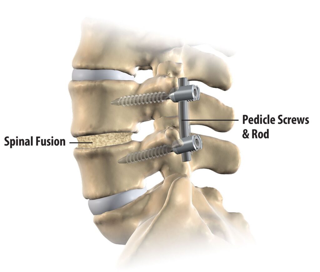 Spinal Fusion Industry