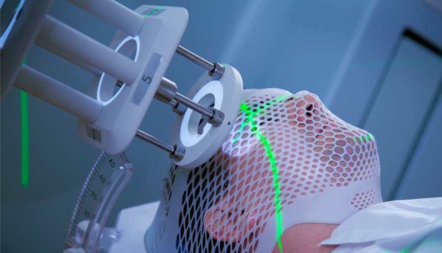 Stereotactic Radiation Therapy Industry