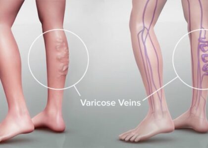 Global Varicose Vein Treatment Industry