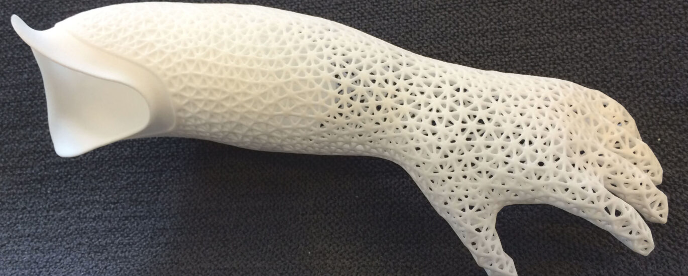 Global 3D Printed Prosthetics Industry