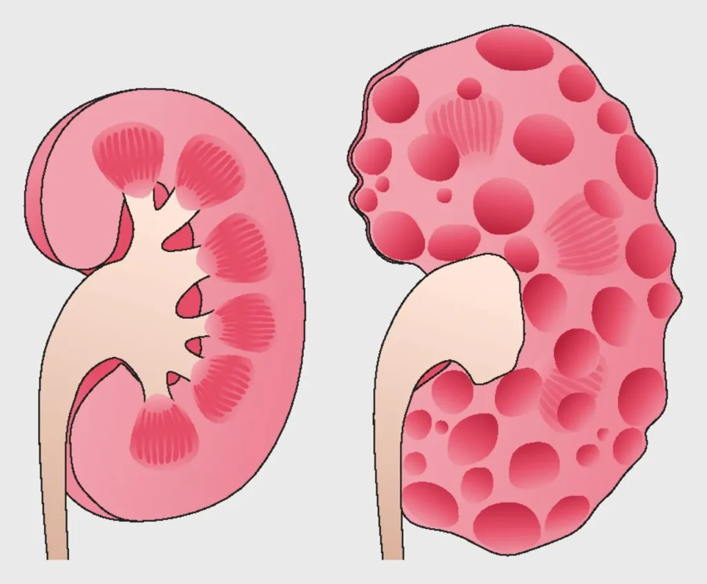 Global Autosomal Dominant Polycystic Kidney Disease Treatment Industry