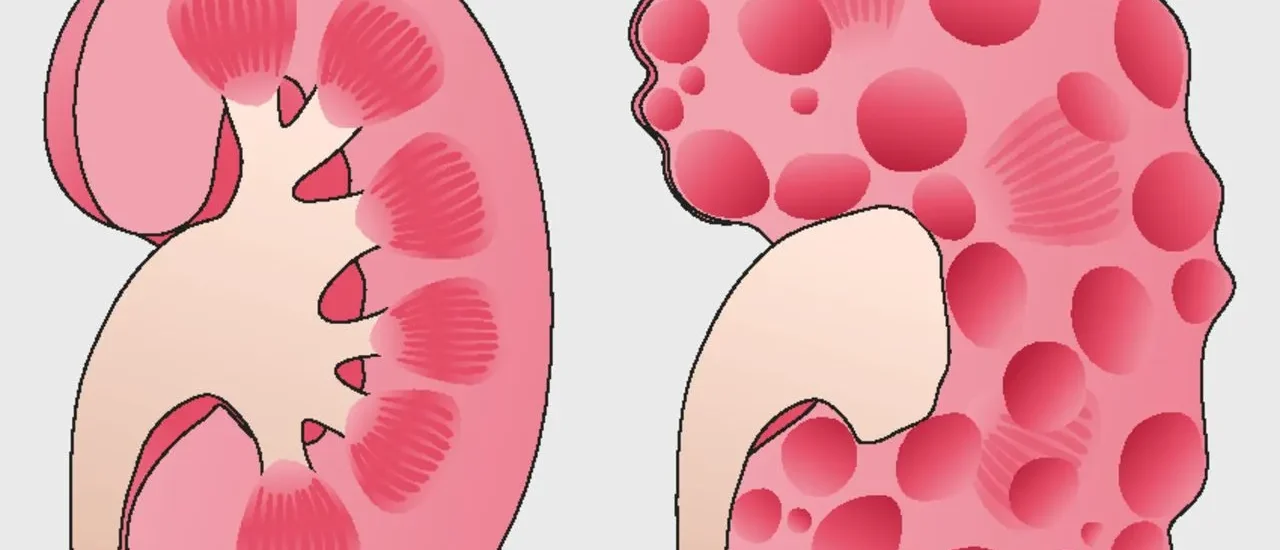 Global Autosomal Dominant Polycystic Kidney Disease Treatment Industry