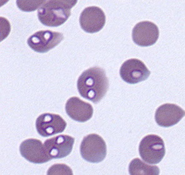 Babesiosis Treatment Market