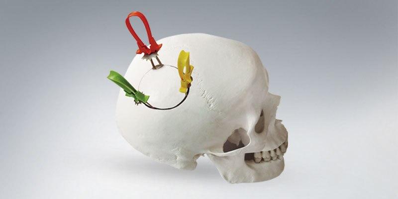 Cranial Stabilizing Devices Industry