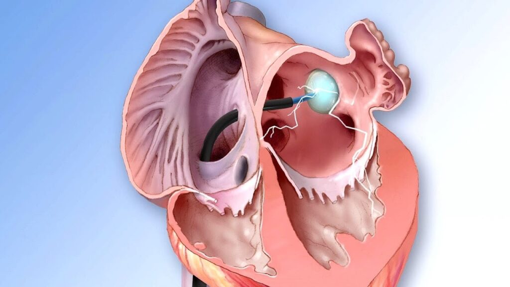 Cryoballoon Ablation System Market