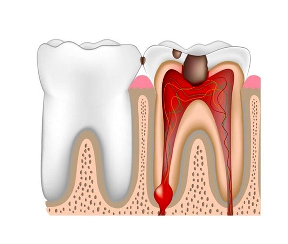 Dental Caries and Endodontic Industry