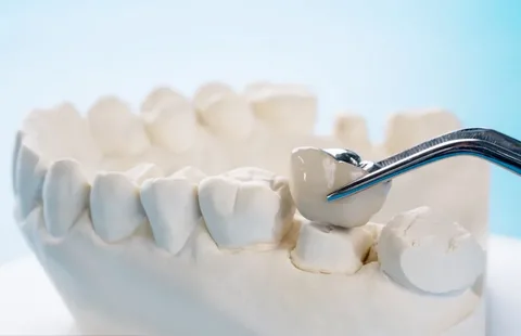 Dental Crown Removal Market