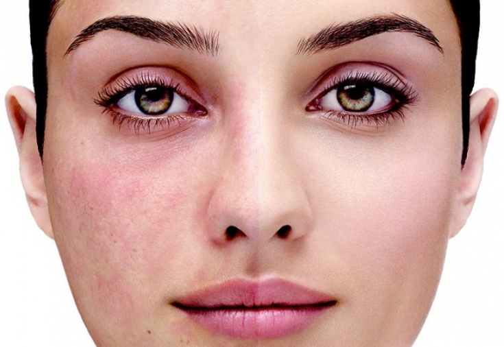 Facial Erythema Treatment Market