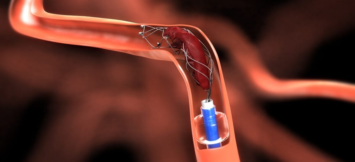 Global Neurovascular Devices Interventional Neurology Industry