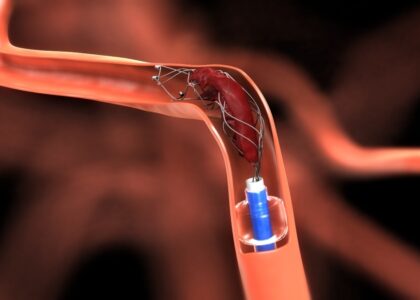 Global Neurovascular Devices Interventional Neurology Industry