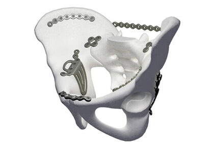 Global Pelvic Reconstruction Industry