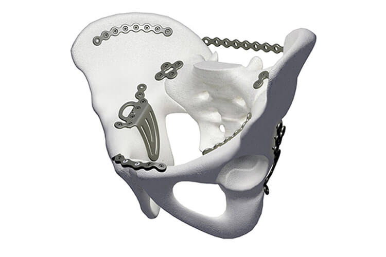 Global Pelvic Reconstruction Industry