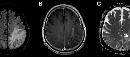 Global Progressive Multifocal Leukoencephalopathy Treatment Industry