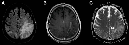 Global Progressive Multifocal Leukoencephalopathy Treatment Industry