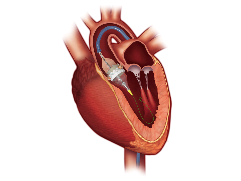 Transcatheter Heart Valve Replacement Market