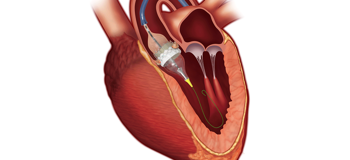 Transcatheter Heart Valve Replacement Market