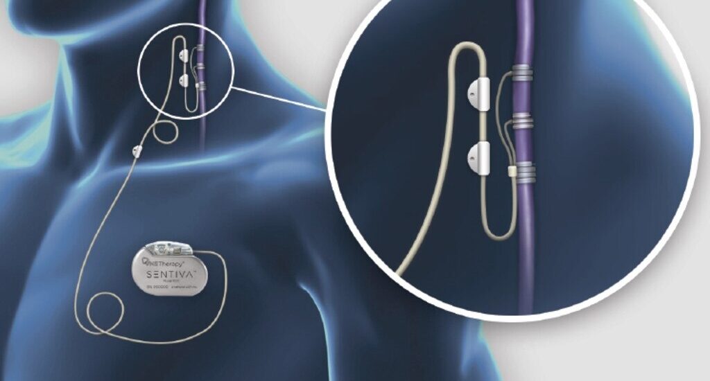 Global Vagus Nerve Stimulator Industry