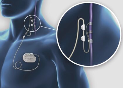 Global Vagus Nerve Stimulator Industry