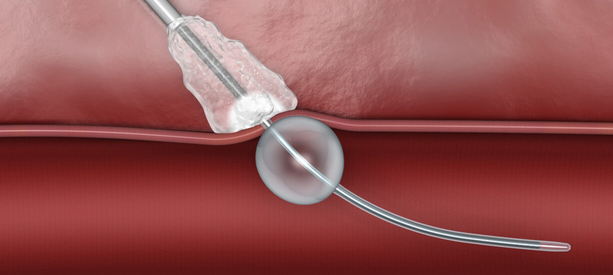 Global Vascular Closure Devices Industry