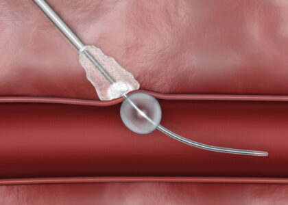 Global Vascular Closure Devices Industry