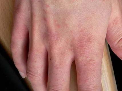 Hand Eczema (HE) Treatment Market