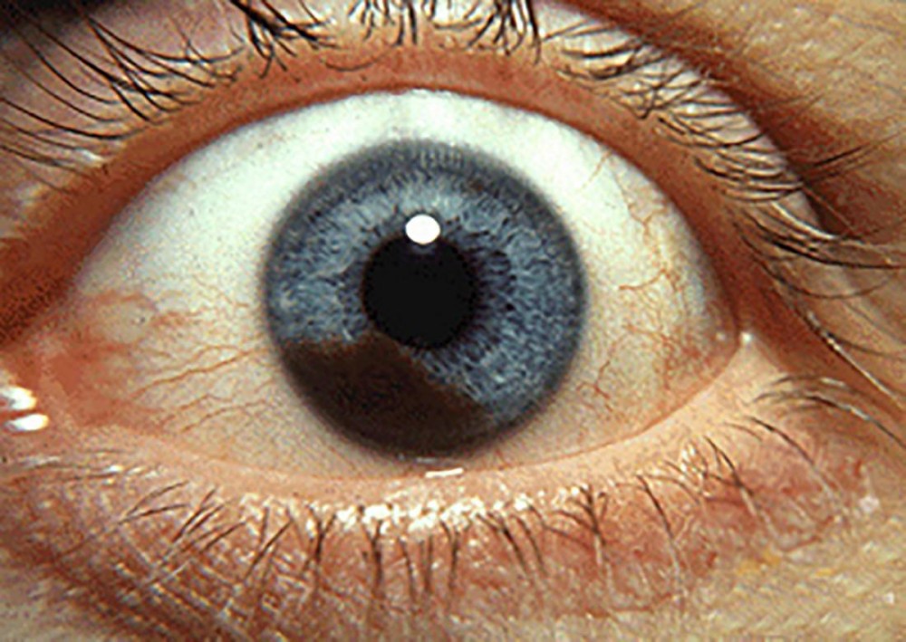 Intraocular Lymphoma Treatments Market