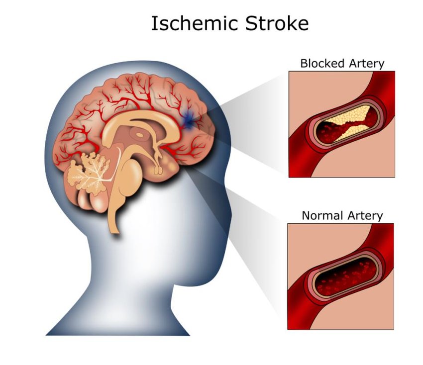 Ischemic Stroke Aspiration Systems Market