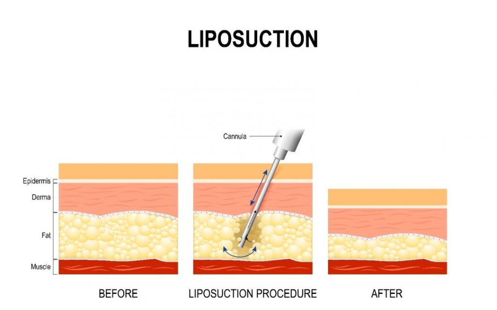 Liposuction Surgery Devices Market