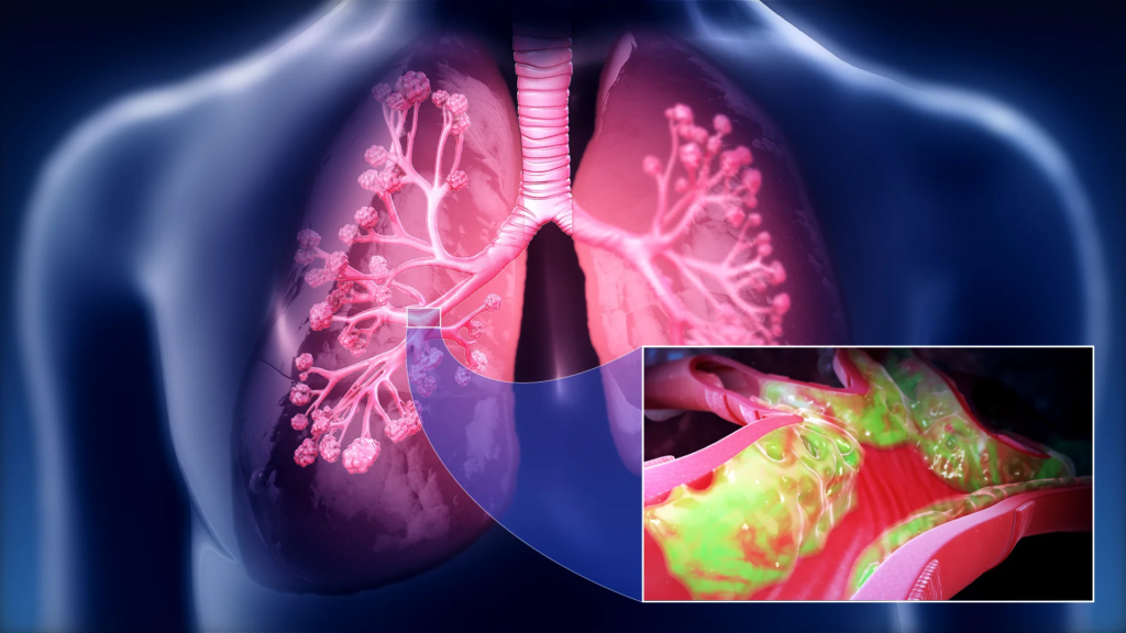 Lung Disease Therapeutics Market