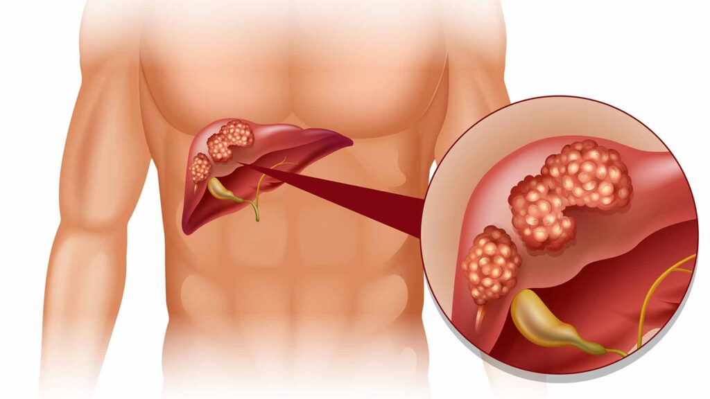 Neuroendocrine Carcinoma Treatment Industry