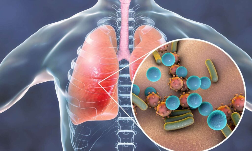 Pneumonia Diagnostics Industry