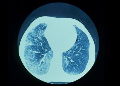 Global Progressive Fibrosing Interstitial Lung Diseases (PFILD) Treatment Industry