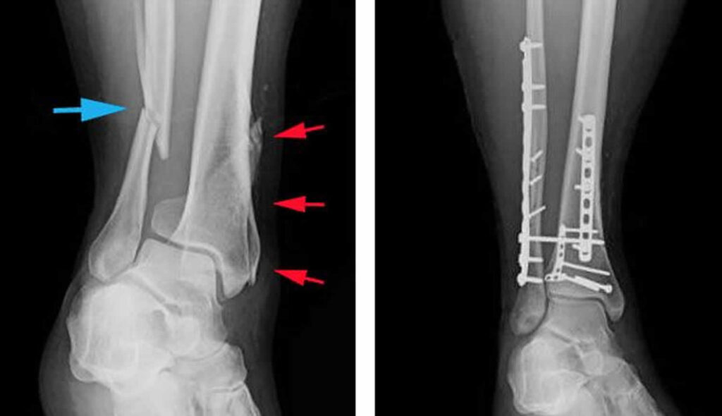 Rib Fracture Repair Systems Market