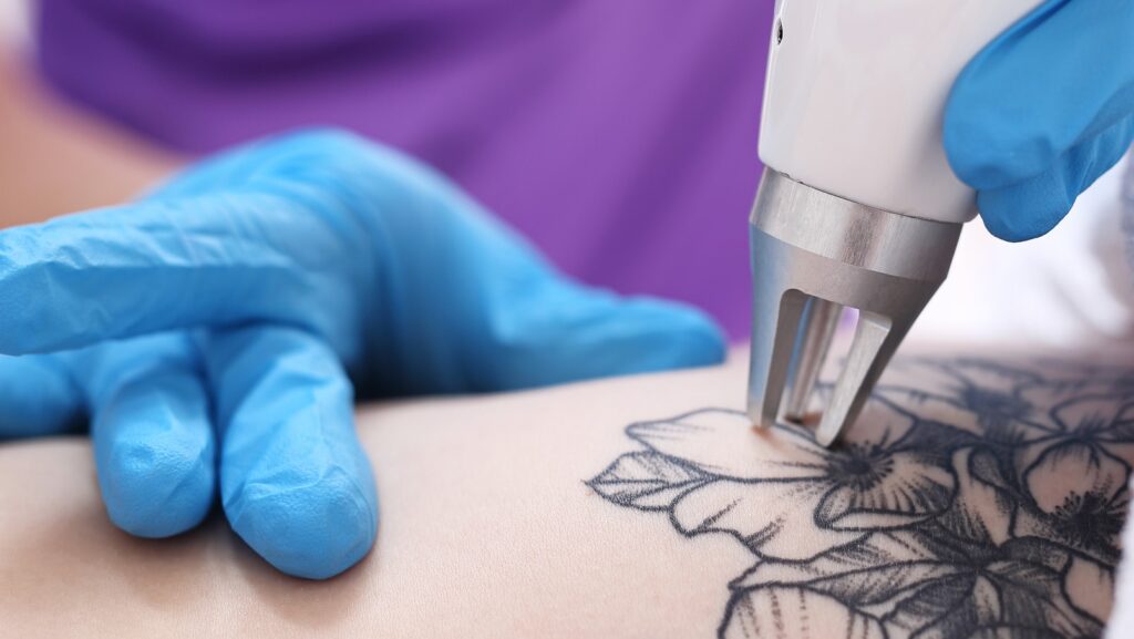 Tattoo Removal Lasers Market