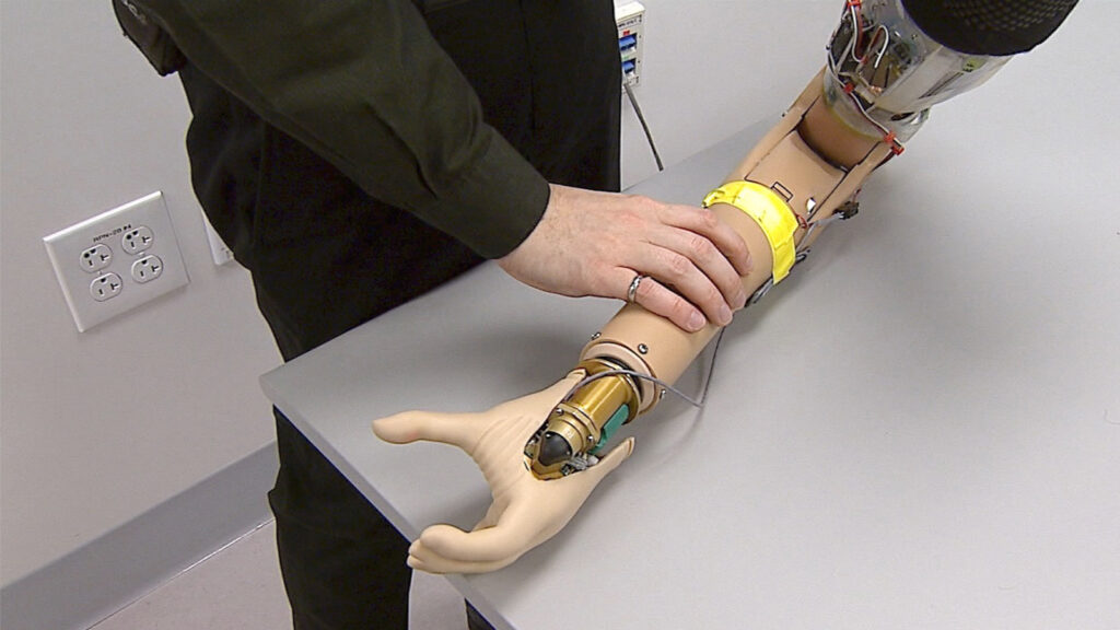 Upper Limb Prosthetics Market