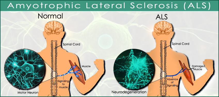 Amyotrophic Lateral Sclerosis Market