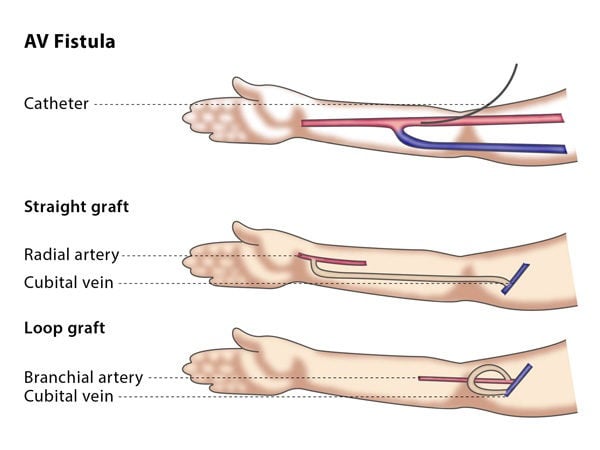 Arteriovenous Fistula Treatment Market