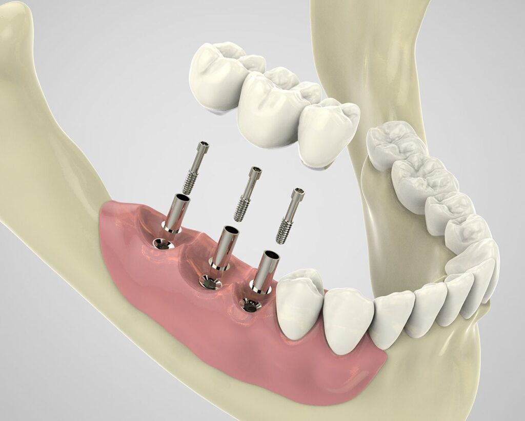 Dental Implants and Prosthetics Market