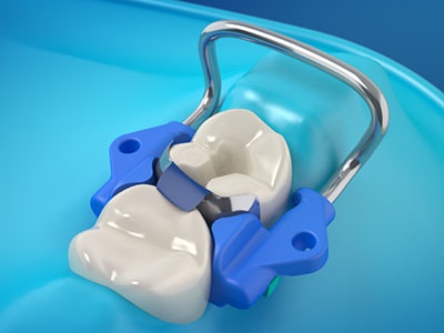 Dental Matrix Systems Market