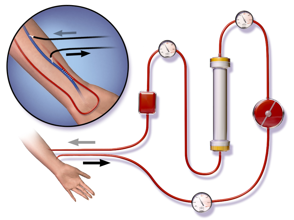 Dialysis Device and Concentrates Market